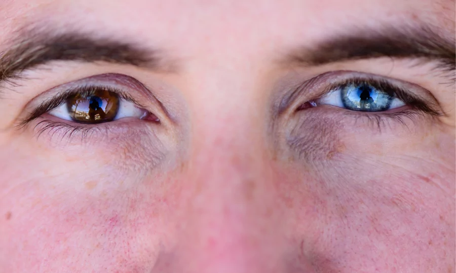 Read Insights about Heterochromia from Auckland Eye