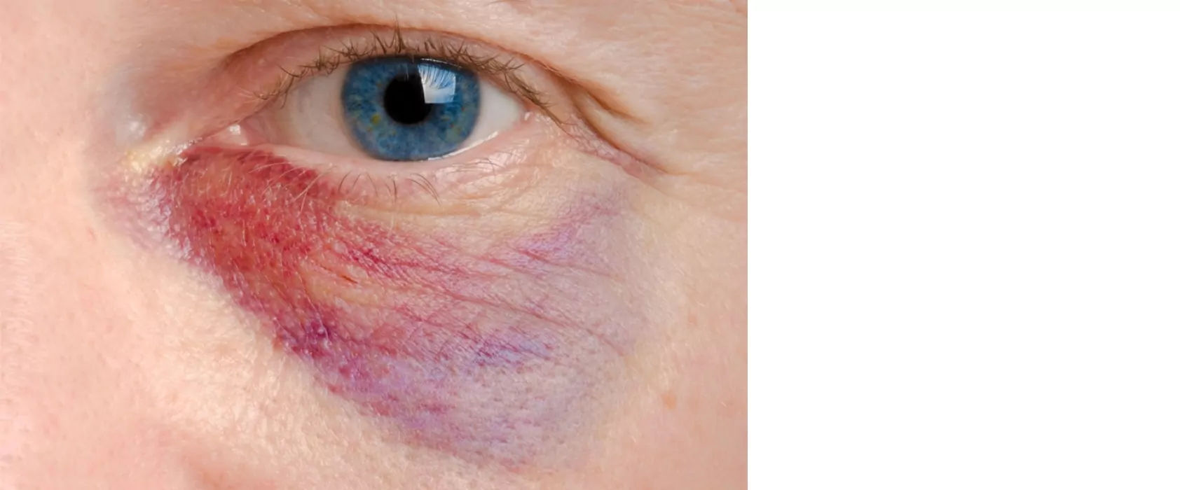 A close up photo of a bruised eye