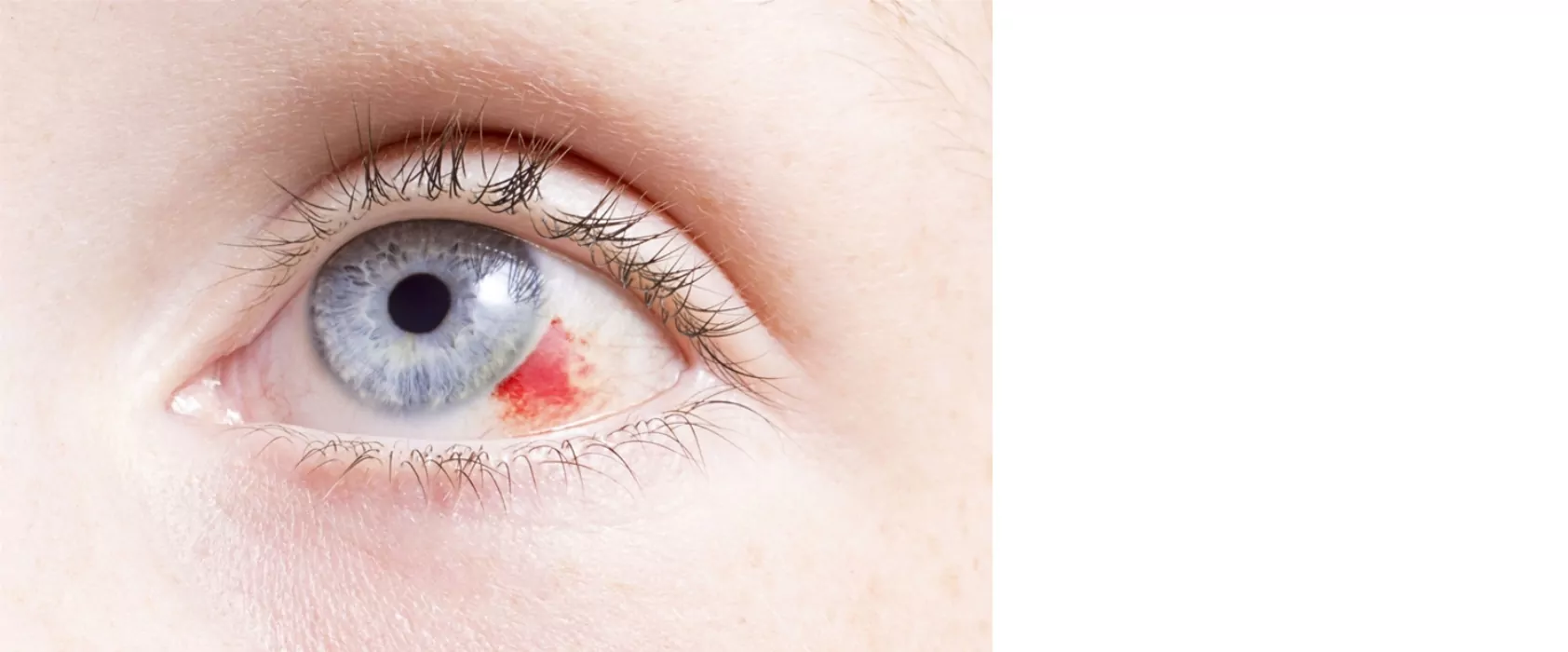 A close up photo of an eye with a blood in it