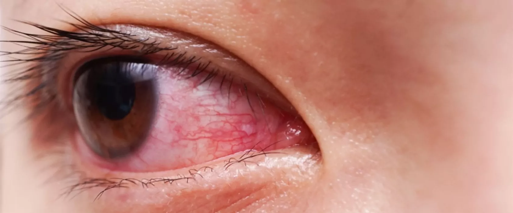 Bloodshot Eyes – Should You Be Concerned?