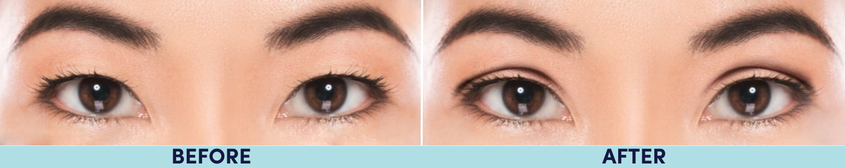 Asian blepharoplasty, also known as double eyelid surgery