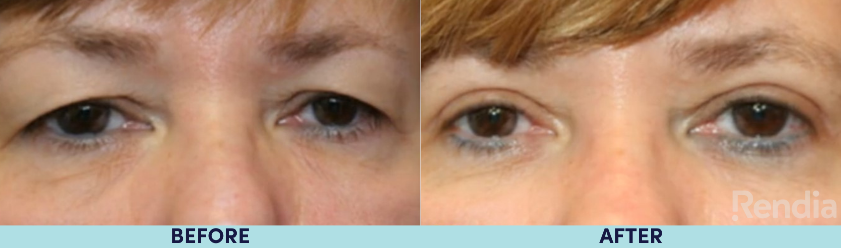 Upper eye lid blepharoplasty before and after