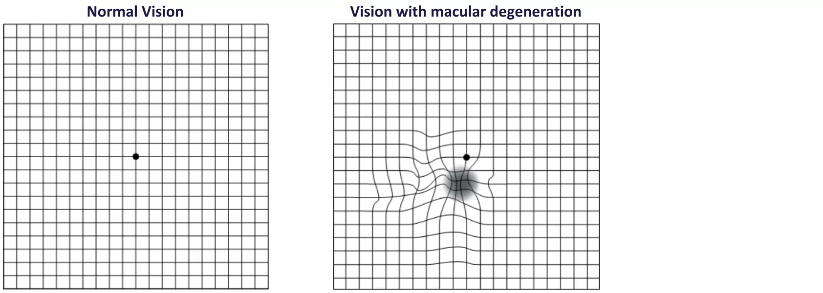 https://www.aucklandeye.co.nz/wp-content/uploads/2022/10/amsler-grid.jpg