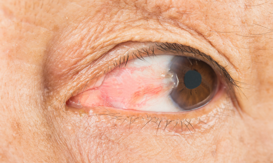 What is a pterygium or surfer’s eye?