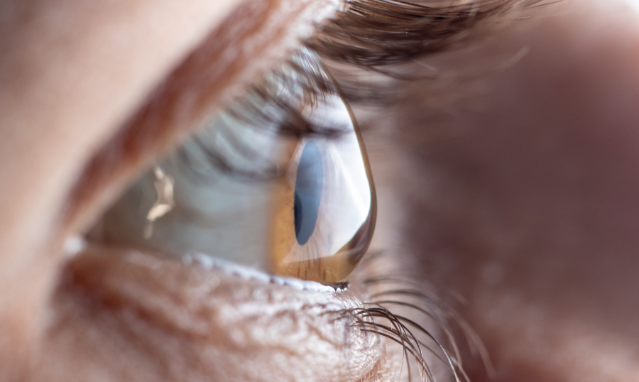 Struggling to focus? You may have keratoconus
