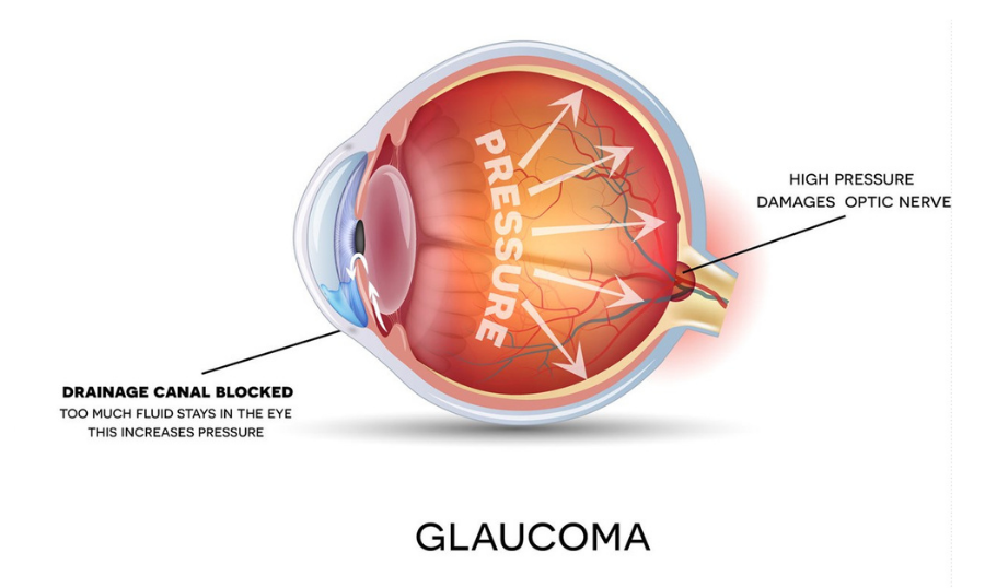 What increases the risk of Glaucoma?