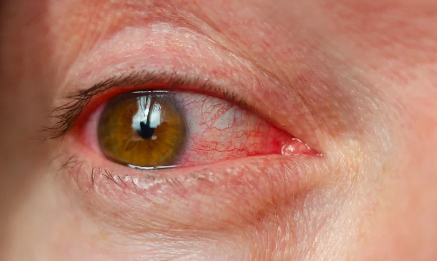 Red Bloodshot Eyes: A Cause For Concern?