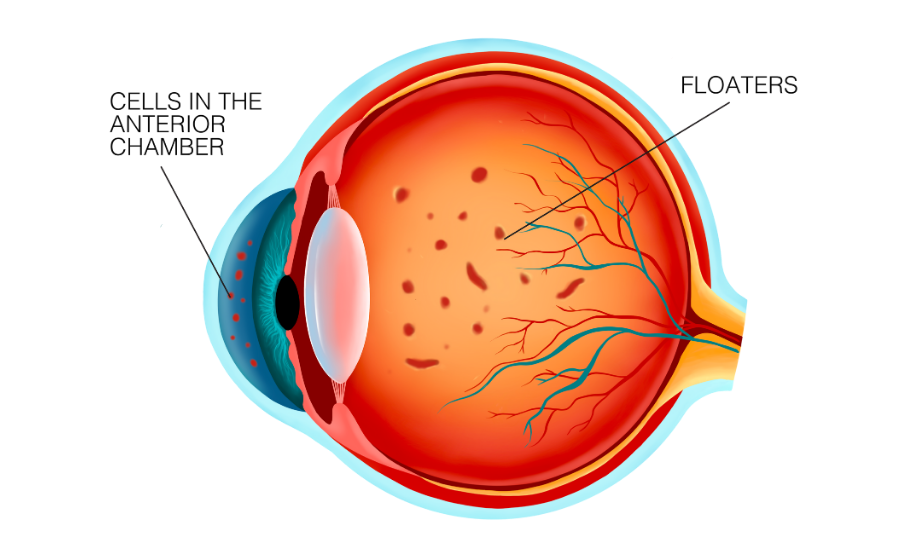 Eye Floaters and Flashes