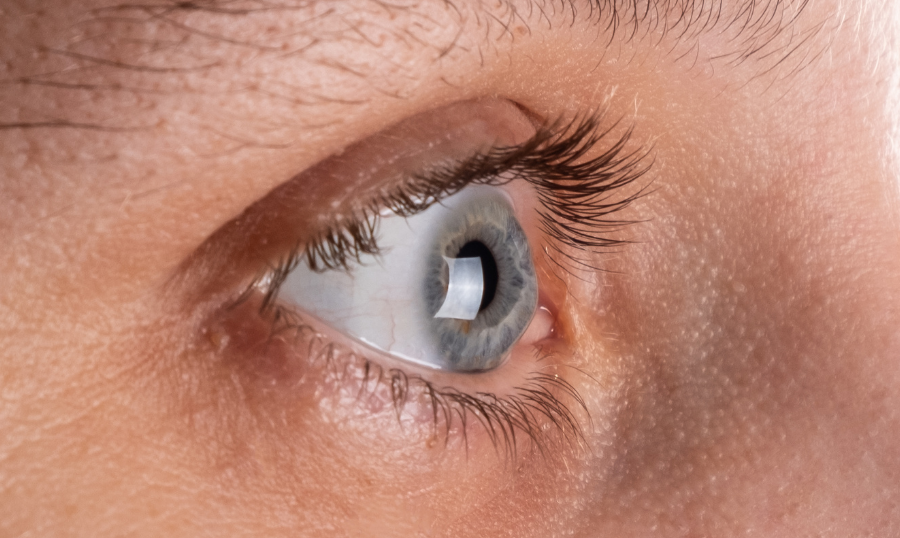 Everything You Need to Know About Keratoconus