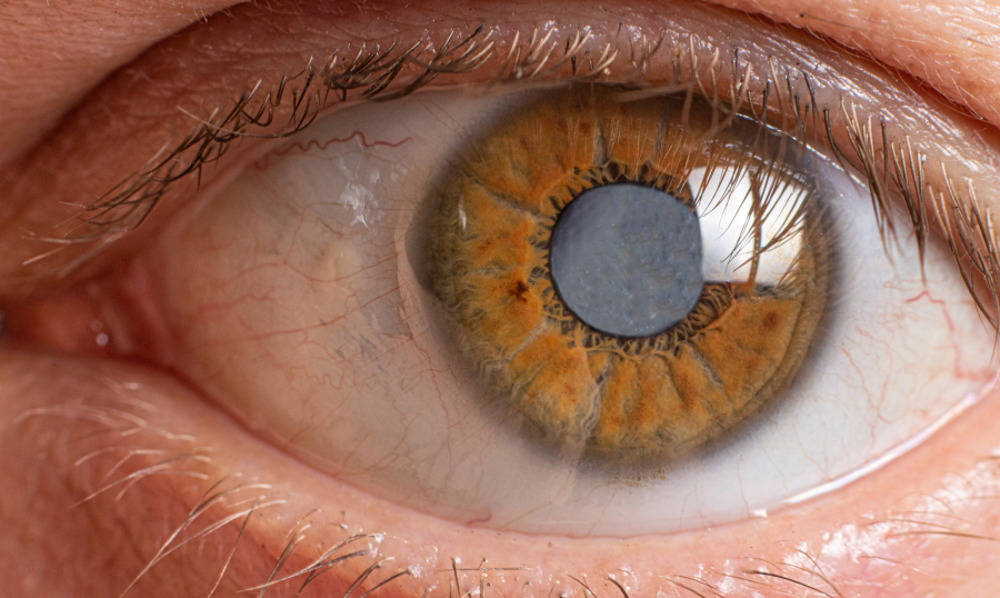 What happens during cataract surgery?