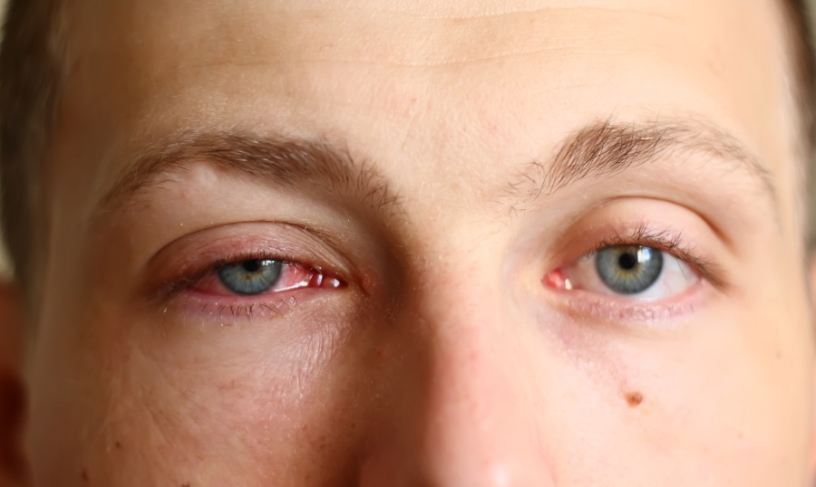 Conjunctivitis: What You Need to Know