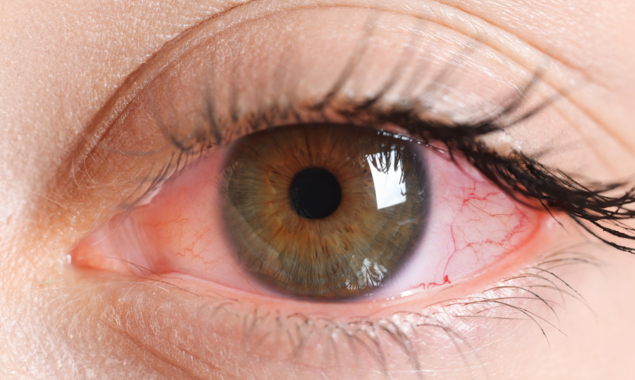 Red Eyes: Common Causes and When To Take Action