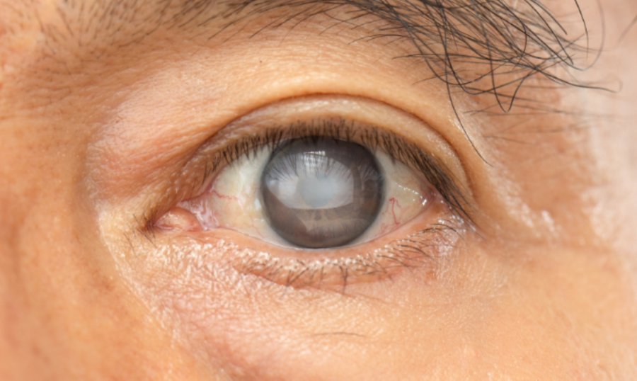 What Are the Risks of Delaying Cataract Surgery?